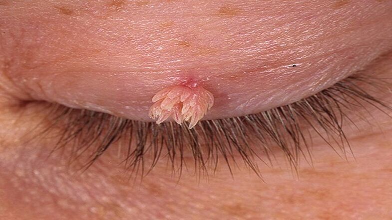 papilloma of the eyelid