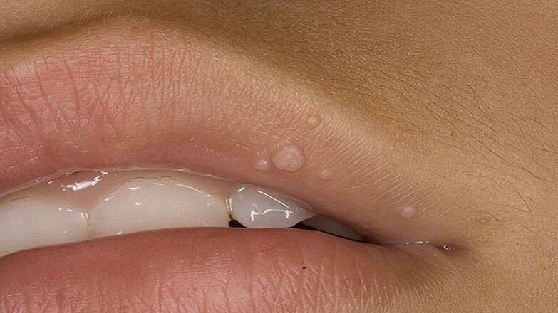 papilloma of the lips