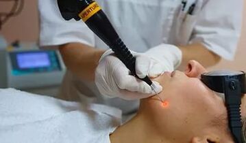 An effective procedure for removing facial papilloma with a laser