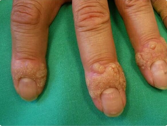 how to remove warts on the fingers