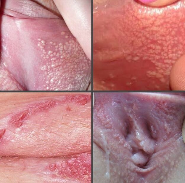 What papillomas look like on the labia