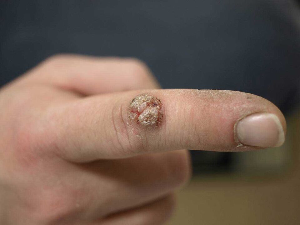 A large wart on the finger that requires removal