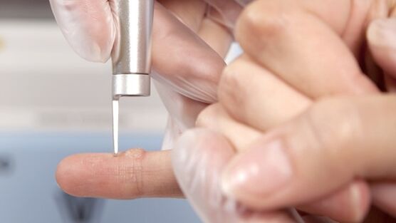One of the methods of removing warts is the use of a laser
