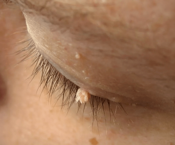 Film papillomas