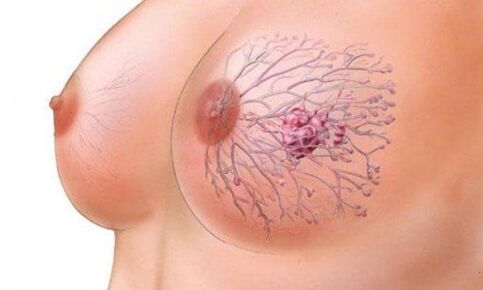 Chest papilloma