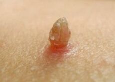 Papilloma