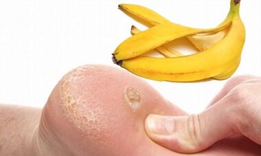 Banana Peel for the treatment of plantar wart
