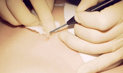 Surgical removal of the plantar wart