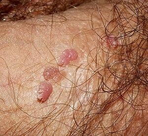 Papillomas on the penis
