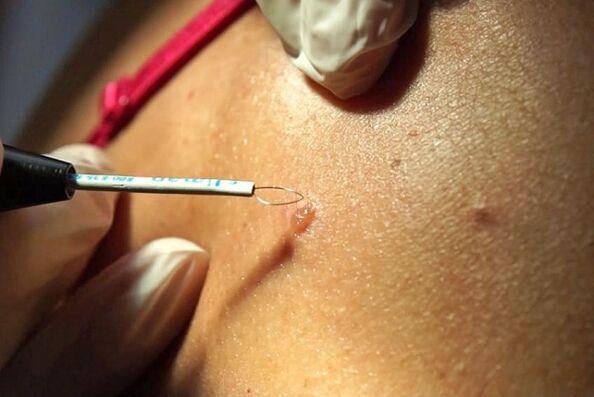 Removal of papillomas with the radio wave method