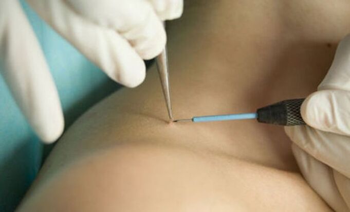 using radio wave therapy