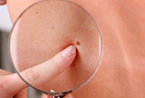 causes of the appearance of papillomas on the human body