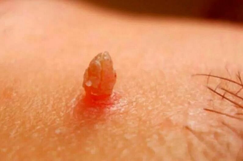 genital warts on the body