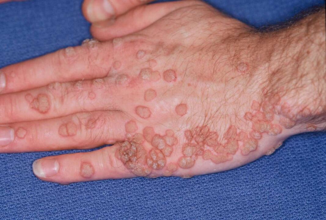many papillomas on hands
