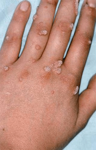 papillomas of the hand