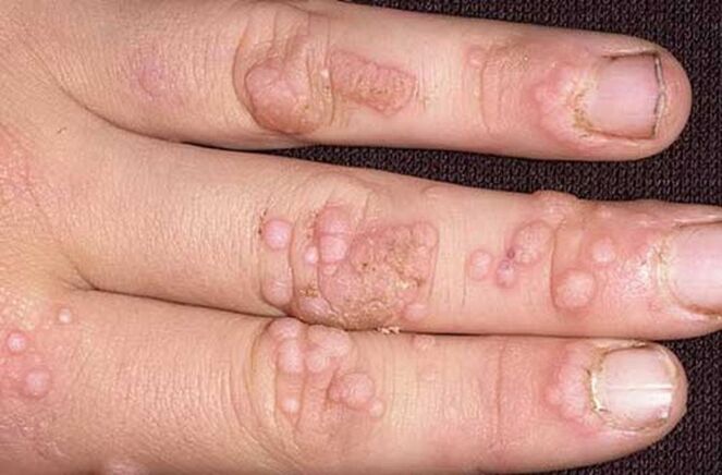 simple papillomas of the hand