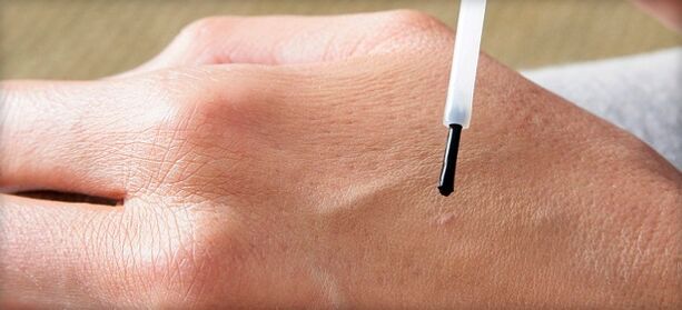 treatment of warts with drugs