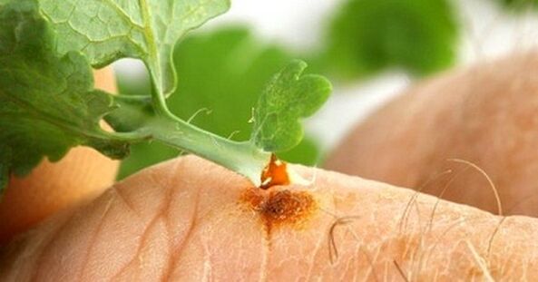 treatment of warts with jaundice