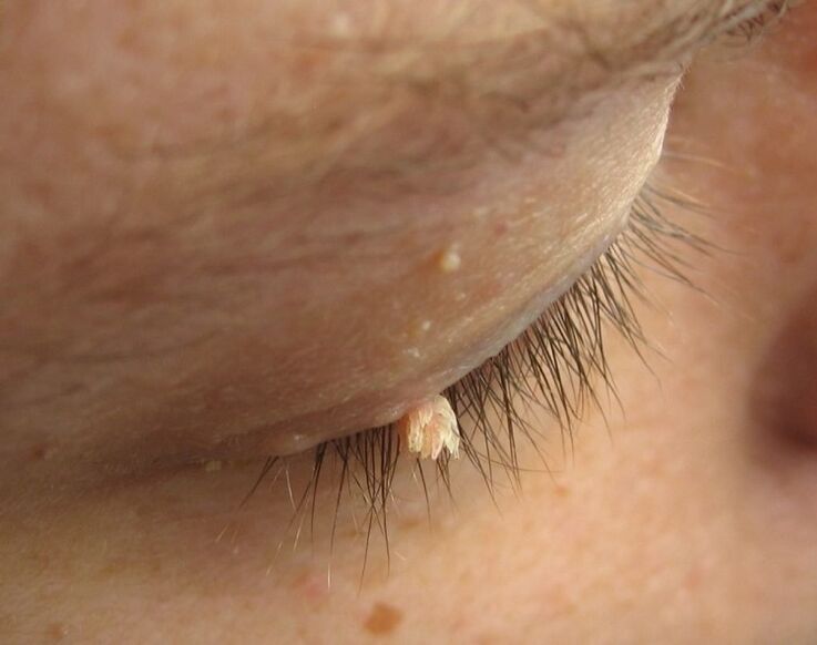 condylomas of the eyelid