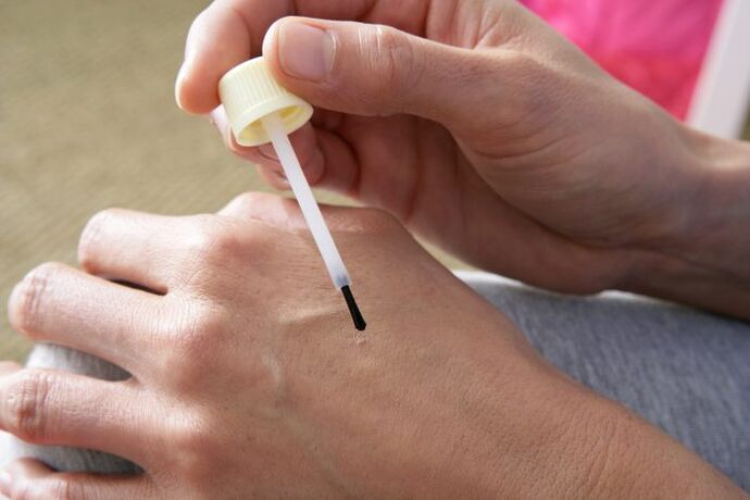 scalding warts with celandine juice