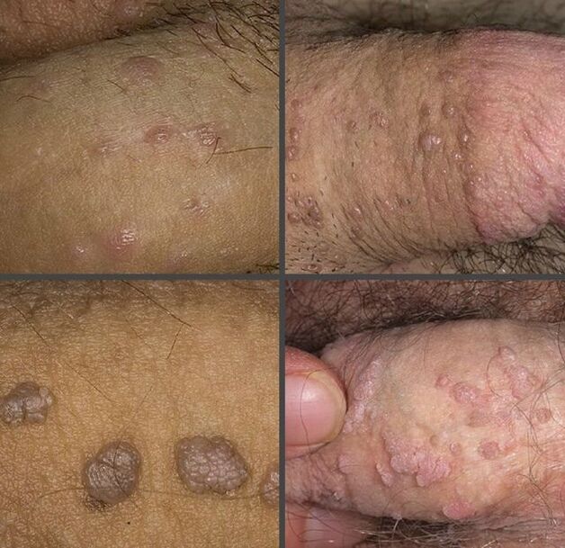 Types of warts
