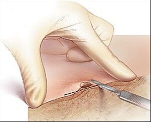 Surgical excision of the wart