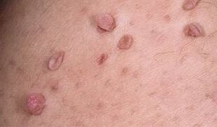 the causes of papillomas on the body